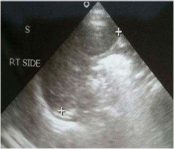 Situs Inversus With Dextrocardia